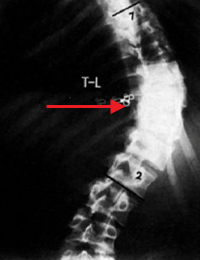 Scoliosis Scoliosis (5).gif